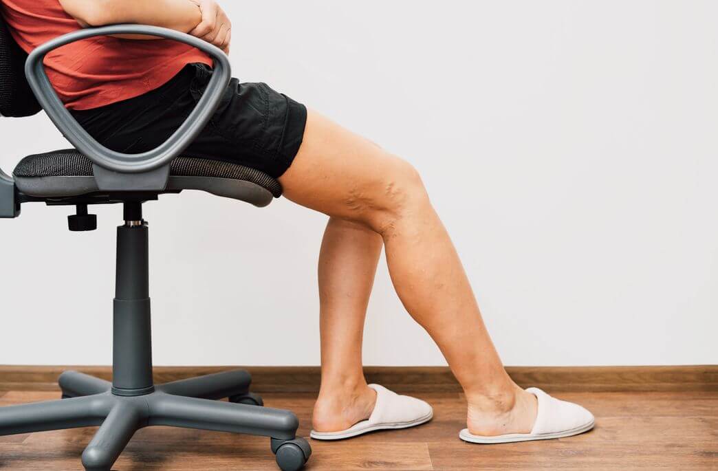 How to Treat Blood Clot Symptoms in Legs?