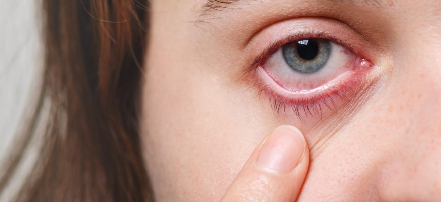 Close-up of a woman holding one eyelid open, revealing her eye and indicating symptoms of dry eyes