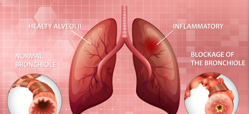 An illustration of chronic obstructive pulmonary disease